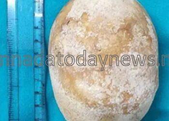 ವಿಶ್ವದಲ್ಲೇ ಅತಿ ದೊಡ್ಡ ಕಿಡ್ನಿ ಕಲ್ಲು ತೆಗೆದ ಮಣಿಪಾಲ ಆಸ್ಪತ್ರೆ ವೈದ್ಯರು