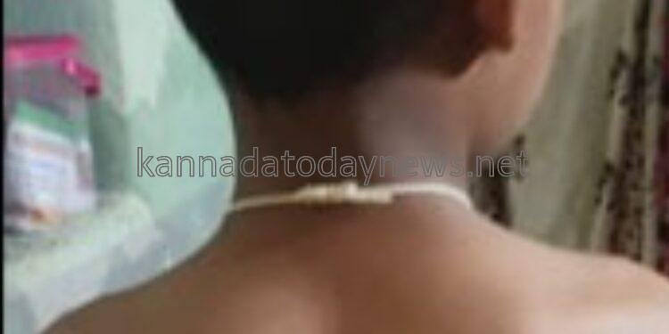 ಎರಡನೇ ತರಗತಿಯ ವಿದ್ಯಾರ್ಥಿಯೋರ್ವನಿಗೆ ಕೋಲಿನಿಂದ ಬಾಸುಂಡೆ ಬರುವಂತೆ ಹೊಡೆದ ಶಿಕ್ಷಕ