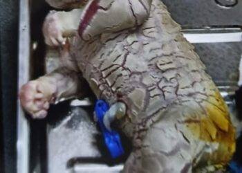 ಭಟ್ಕಳದಲ್ಲಿ ಖಾಸಗಿ ಆಸ್ಪತ್ರೆಯಲ್ಲಿ ಭಯಾನಕ ರೂಪದ ಹೆಣ್ಣು ಶಿಶು ಜನನ