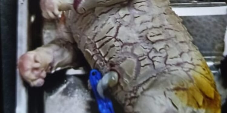 ಭಟ್ಕಳದಲ್ಲಿ ಖಾಸಗಿ ಆಸ್ಪತ್ರೆಯಲ್ಲಿ ಭಯಾನಕ ರೂಪದ ಹೆಣ್ಣು ಶಿಶು ಜನನ