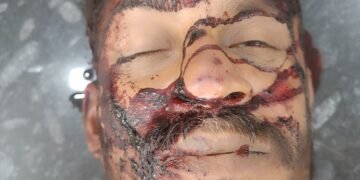 ಭಟ್ಕಳದಲ್ಲಿ ಭೀಕರ ರಸ್ತೆ ಅಪಘಾತ: ಬೈಕ್ ನಿಯಂತ್ರಣ ತಪ್ಪಿ ವ್ಯಕ್ತಿ ಸ್ಥಳದಲ್ಲೇ ಸಾವು:ಮುರುಡೇಶ್ವರದಿಂದ ಬೈಲೂರು ಕಡೆಗೆ ಪ್ರಯಾಣದ ವೇಳೆ ದುರಂತ